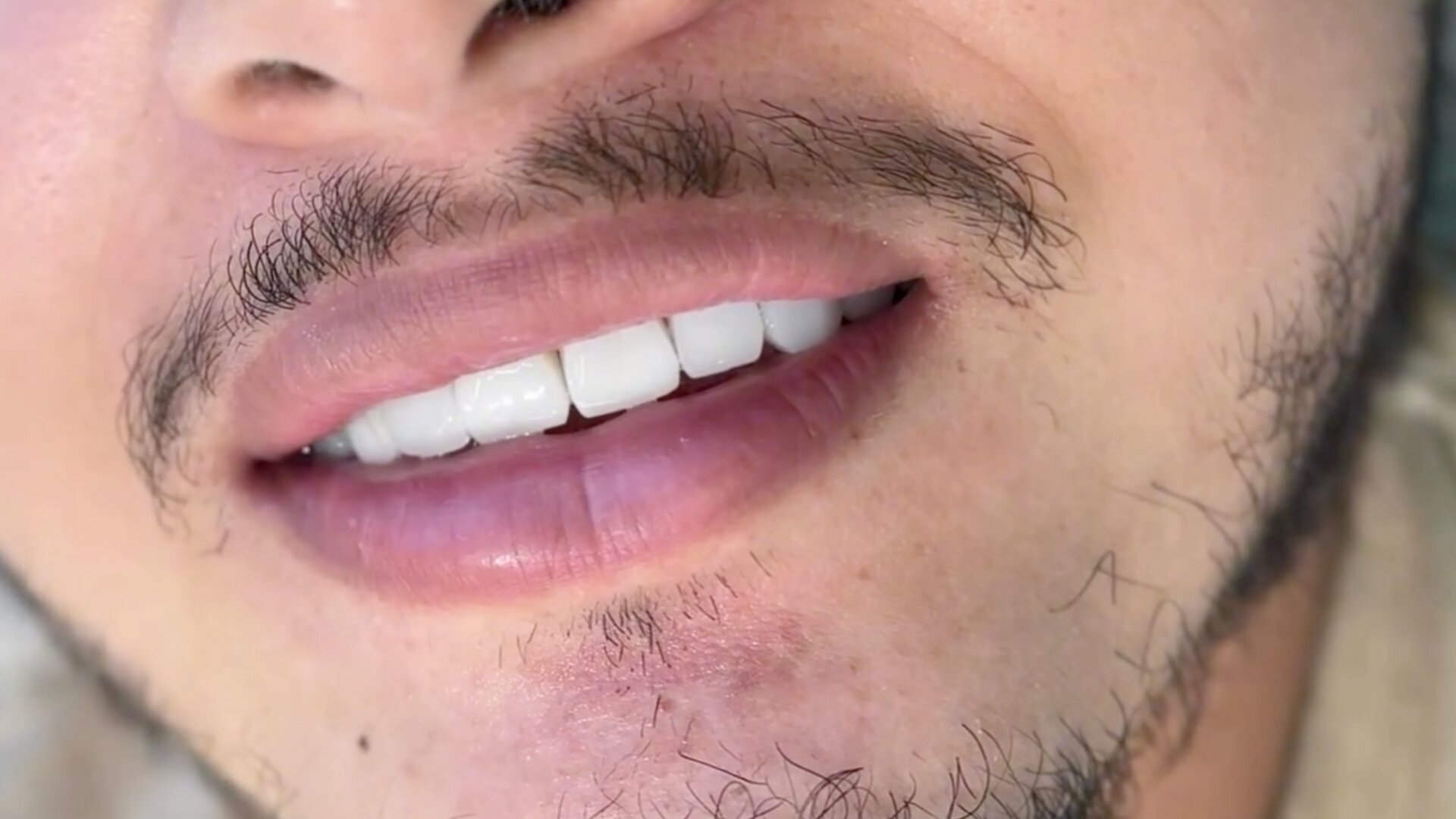 Depois — Harmonização do Sorriso